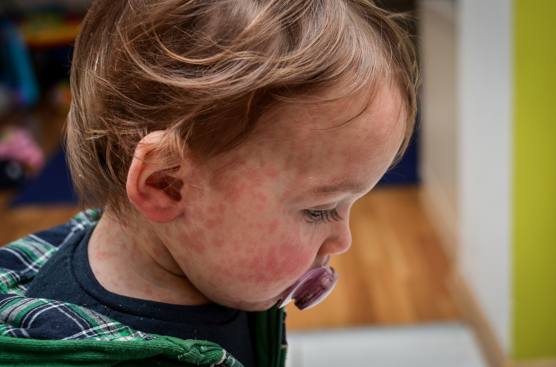Measles: Learn more here.