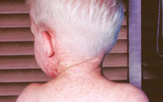 a child suffering from measles, picture taken from the back with measles symptoms visible